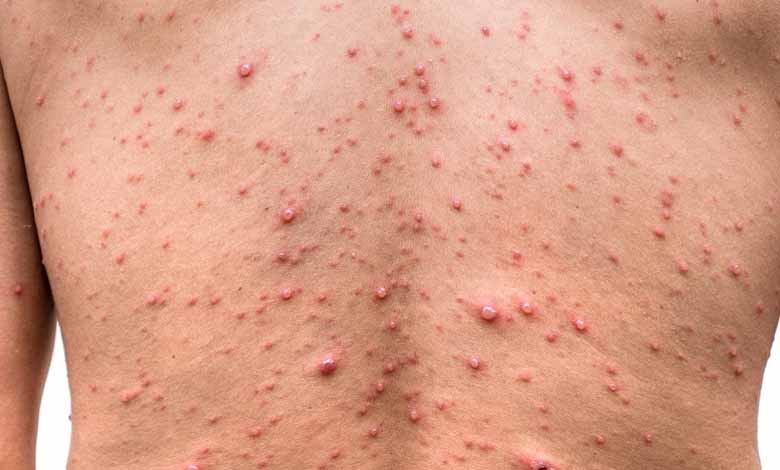 الولايات المتحدة تسجل قرابة 24 ألف حالة إصابة بجدرى القرود